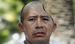 Chiếc đầu biến dạng của người đàn ông bị mất 1/4 hộp sọ