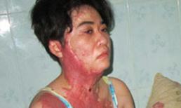 Nỗi đau của người vợ bị chồng tạt xăng thiêu sống