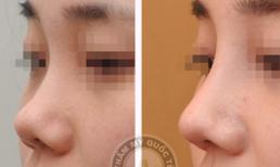 Quan niệm muốn đẹp phải chịu đau đã lỗi thời