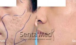 Xóa sẹo lõm do trứng cá  siêu tiết kiệm 