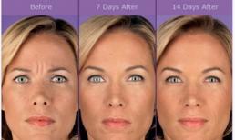 Giải oan cho Botox