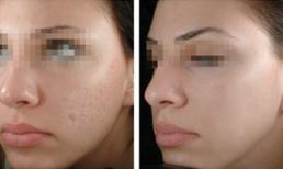 Trị sẹo lõm bằng công nghệ Thermage