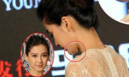 Angelababy lộ cằm "thừa thịt" phồng rộp bất thường