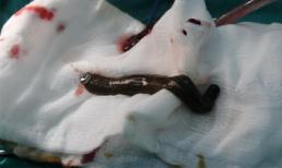 Gắp đỉa dài 20cm trong bàng quang một bệnh nhi