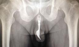 Chiếc dĩa dài 10 cm nằm gọn trong 'của quý' cụ ông