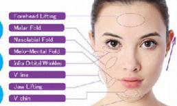 Căng da mặt bằng chỉ Ultra Vlift