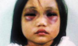 Bé gái 5 tuổi bị cha hành hạ tàn nhẫn