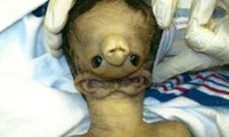 Em bé có hai tai hợp nhất, mọc dưới cổ