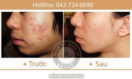 Bí quyết để chị em tự tin nói không với mụn