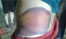 Hà Nội: Bắt ép người mù cho quan hệ tình dục rồi đánh đập dã man