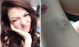 Fan xót xa vì Hồng Quế bị bầm tím chân trông phát sợ