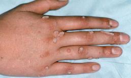 Bệnh mụn cơm: Dấu hiệu nhận biết và cách phòng bệnh