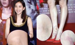Lưu Thi Thi bị soi chân tay đầy sẹo và vết bầm dập