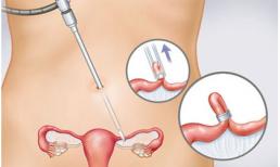 Suýt chết vì quên vòng tránh thai 32 năm trong ổ bụng