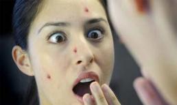 Bị mụn ở 15 vị trí sau sẽ vô cùng nguy hại sức khỏe!