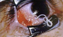 Hình ảnh giun ký sinh lúc nhúc trong mắt người gây sốc