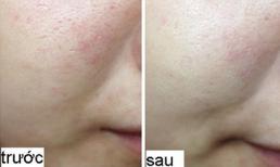 Phương pháp mới thu hẹp lỗ chân lông và trắng da mặt khuyến mại 60%
