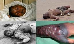 Dấu hiệu nhận biết sớm và cách để tránh lây nhiễm Ebola