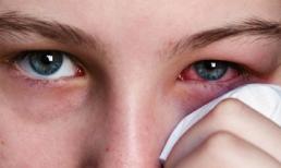 Cách xử lý khi bị đau mắt đỏ