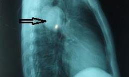 Bác sĩ kinh hãi khi thấy hàng nghìn sán chó ở phổi bệnh nhân