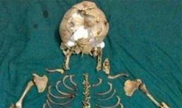 Ấn Độ: 'Choáng' với bào thai nằm suốt 36 năm trong bụng mẹ