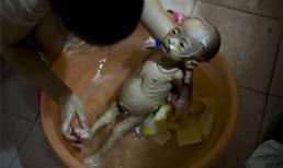 Cô bé gầy trơ xương do mắc bệnh lạ đã qua đời