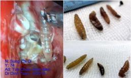 Kinh hãi khi gắp được 20 con giòi lúc nhúc trong mũi bệnh nhân
