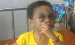 Bé 4 tuổi bị đánh chấn thương sọ não bị bên nội từ chối