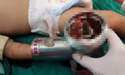 Bàn tay trẻ em bị cuốn vào máy xay thịt