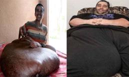 Mắc bệnh lạ, có khối u, tinh hoàn nặng cả trăm kg