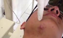 Rùng mình với màn bắt dòi trên mặt quân nhân Brazil