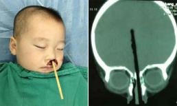 TQ: Bé trai 2 tuổi bị đũa chọc từ mũi lên não