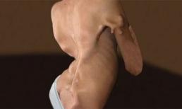 Cô bé Trung Quốc 14 tuổi có cơ thể dần đông cứng như hóa đá