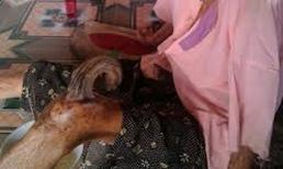 Kỳ lạ: Cụ bà gần trăm tuổi mọc sừng ở đầu gối