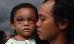 Bé 4 tuổi bị hành hạ ở Bình Dương đã xuất viện