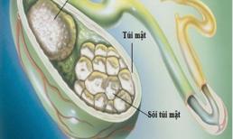 Mẹo đơn giản ngăn ngừa sỏi mật