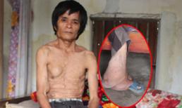 Người đ&#224;n &#244;ng mang khối u nặng 7kg ở ch&#226;n