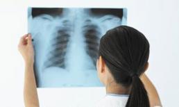 10 dấu hiệu cảnh báo sớm bệnh ung thư phổi