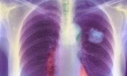 Bài thuốc "dĩ độc trị độc" chữa được bệnh ung thư cho nhiều người