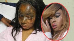 Khuôn mặt tàn tạ của nhân viên Victoria's Secret bị tạt axit