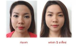 Loạt ảnh trước và sau phẫu thuật thẩm mỹ của những cô gái Thái