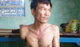 Người đàn ông chân tay bị khô héo rồi rụng dần ở Khánh Hòa