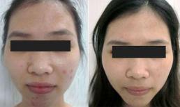 Da sạch mụn đón thu với ưu đãi lớn từ Elly Queen