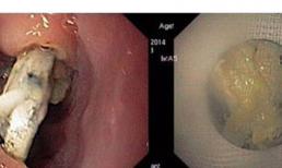 Kinh hoàng bé 2 tuổi bị hóc pin trong thực quản
