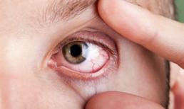 8 tình trạng của mắt cảnh báo bạn đang mắc bệnh hiểm nghèo