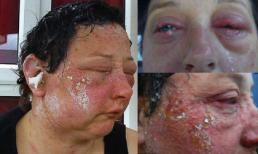 Người phụ nữ hoá 'quái vật' vì dị ứng thuốc nhuộm tóc