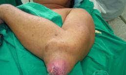 Bệnh gút làm suy giảm 'chuyện ấy'