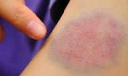 Chảy máu suốt 3 năm vì ăn thịt chó