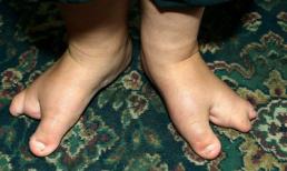 Cậu bé 4 tuổi có đôi bàn chân càng cua