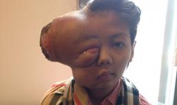 Thiếu nữ bị biến dạng mặt từ khối u bé bằng hạt đậu